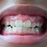 Erosione dentale