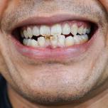 Macchie denti caffè