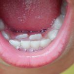 Righe sui denti