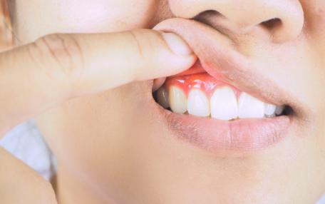 Colletti dentali scoperti