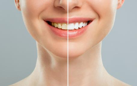 Denti grigi cause