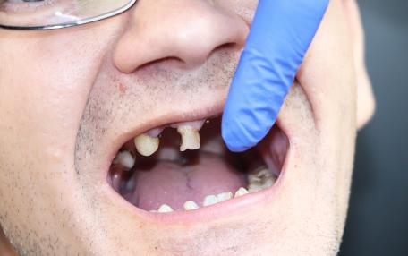 Erosione dentale da reflusso