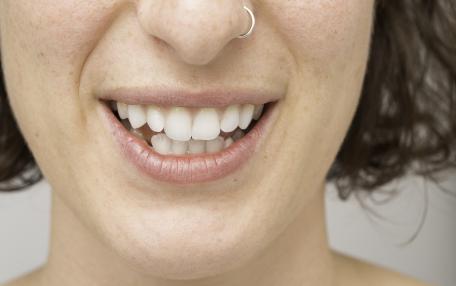 erosione-dentale