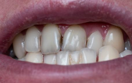 Il caffè macchia i denti