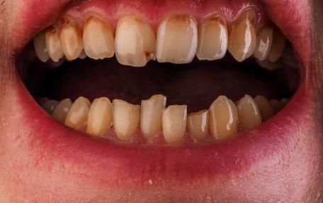 Tartaro denti