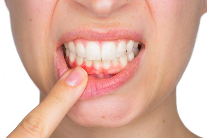 Colletti dentali scoperti Colletti dentali scoperti
