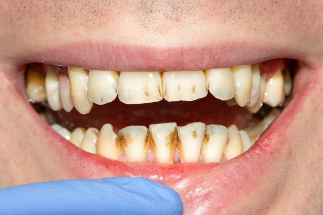 Denti rovinati Denti rovinati