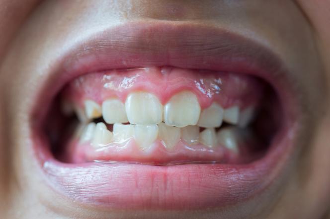 Erosione dentale Erosione dentale