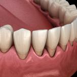 Biorepair gengive