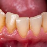 Come eliminare il tartaro dai denti