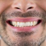 Denti gialli