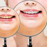 Denti sporchi