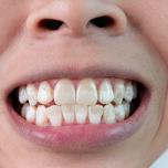Macchie bianche sui denti
