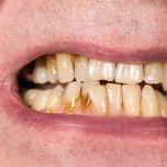 Macchie marroni sui denti