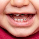 Macchie nere sui denti