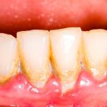 Placca denti
