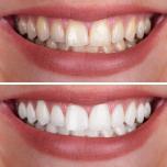 Sbiancante per denti