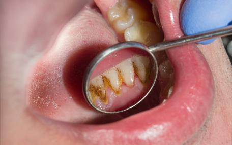 Come eliminare il tartaro dai denti