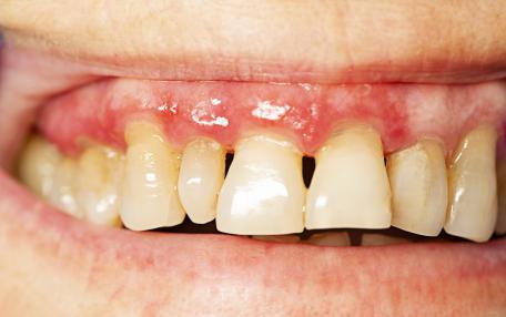 Placca denti