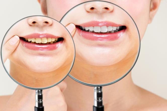 Denti sporchi Denti sporchi