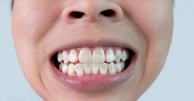 Macchie bianche sui denti Macchie bianche sui denti