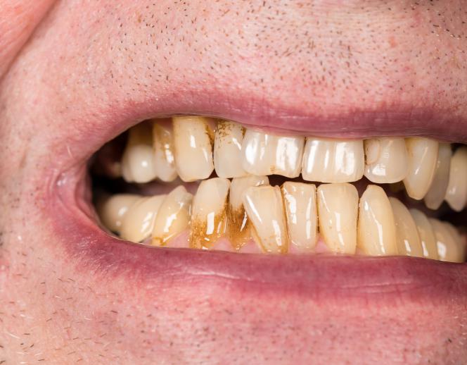 Macchie marroni sui denti Macchie marroni sui denti