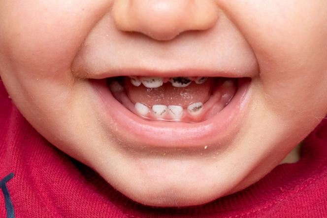 Macchie nere sui denti Macchie nere sui denti