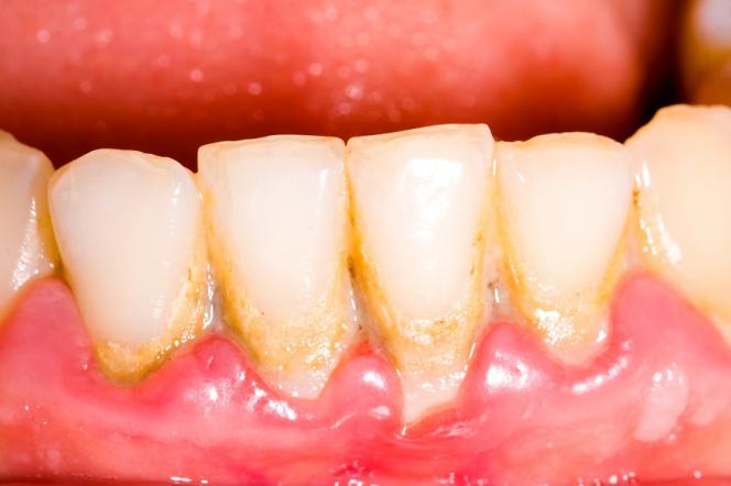 Placca denti Placca denti