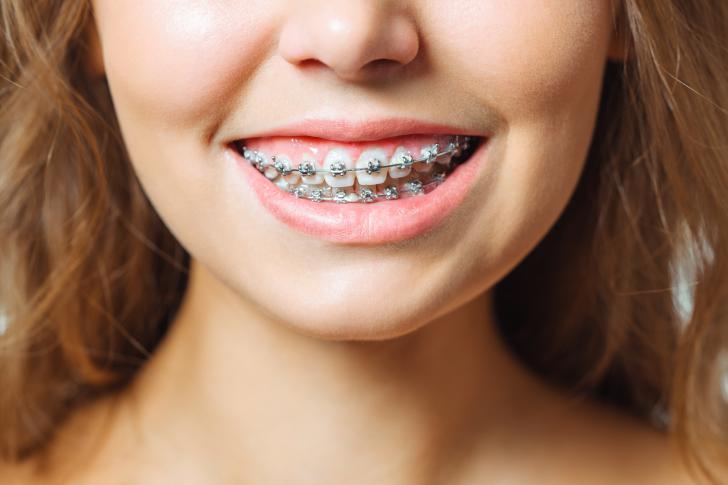Apparecchio denti gratuito Apparecchio denti gratuito