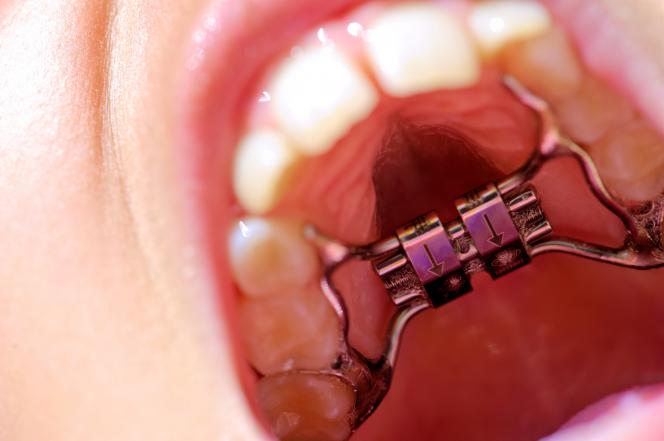 Apparecchio denti interno Apparecchio denti interno