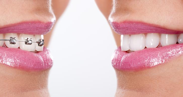 Apparecchi denti prima e dopo Apparecchi denti prima e dopo