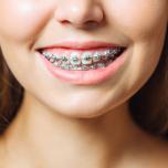 Apparecchio denti gratuito
