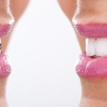 Apparecchi denti prima e dopo