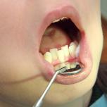 Dente storto davanti
