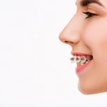 Denti in avanti