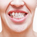 Denti storti adulti