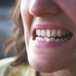 Denti storti bambini