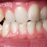 Denti storti dopo apparecchio