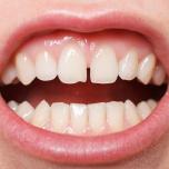 Diastema prima e dopo