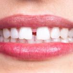 Diastema
