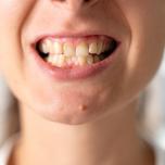 Malocclusione dentale adulti