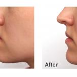 Malocclusione prima e dopo