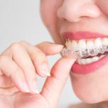 mascherina Invisalign