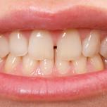 Spazio improvviso tra i denti