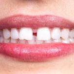 Spazio tra i denti