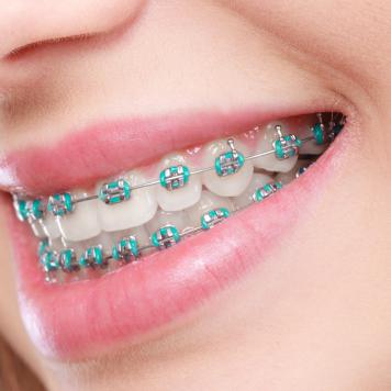 Apparecchio denti gratuito