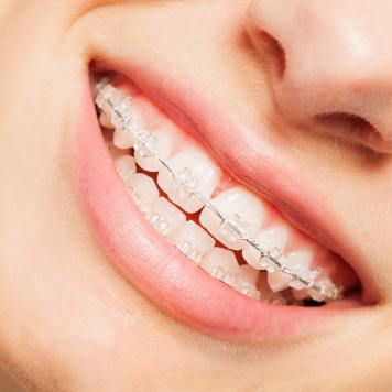 Costo apparecchio denti