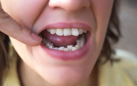Denti storti bambini