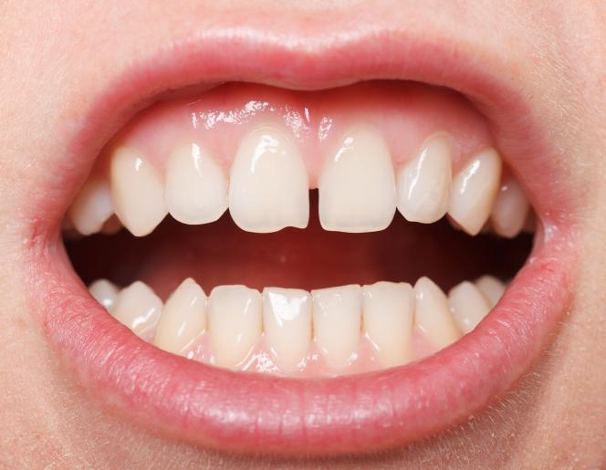 Diastema prima e dopo Diastema prima e dopo