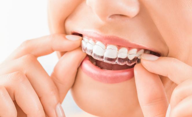 Invisalign opinioni negative Invisalign opinioni negative